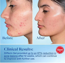 Load image into Gallery viewer, Differin Adapalene Prescription Strength Retinoid Gel 0.1% Acne Treatment , 45g
